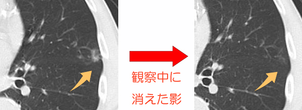 胸のレントゲンで影が見つかった 医療法人芍薬会 灰本クリニック 内科 消化器内科 循環器内科 糖尿病内科 呼吸器内科