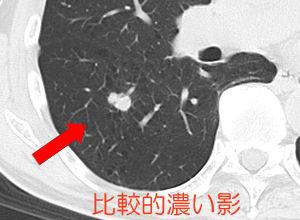 胸のレントゲンで影が見つかった 医療法人芍薬会 灰本クリニック 内科 消化器内科 循環器内科 糖尿病内科 呼吸器内科