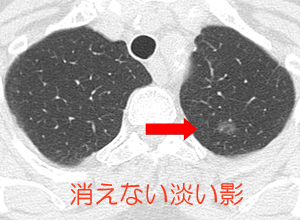 胸のレントゲンで影が見つかった 医療法人芍薬会 灰本クリニック 内科 消化器内科 循環器内科 糖尿病内科 呼吸器内科