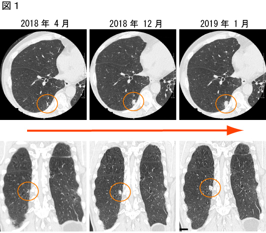 solid nodule2 1.jpg