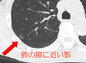 胸のレントゲンで影が見つかった 医療法人芍薬会 灰本クリニック 内科 消化器内科 循環器内科 糖尿病内科 呼吸器内科