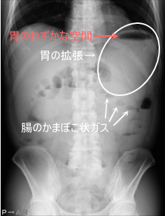 お腹 ポコポコ お なら