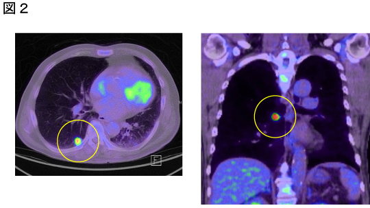 solid nodule2 2.jpg